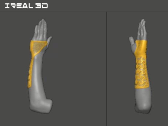 3D扫描帮助定制骨科术后患者治疗方案